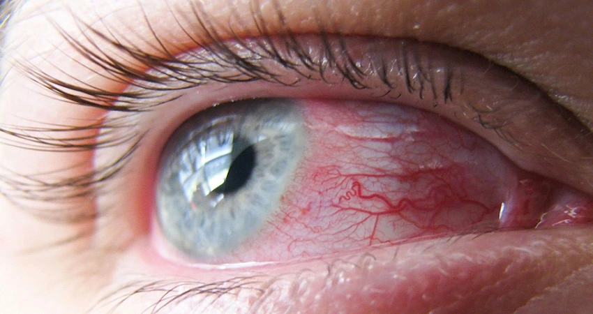 چشم آسیب دیده در اثر سوختگی با مواد شیمیایی