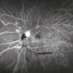 آنژیوگرافی شبکیه چشم فرد مبتلا به دیابت