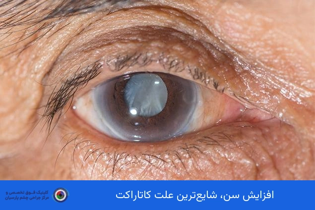 افزایش سن (شایع‌ترین علت کاتاراکت)