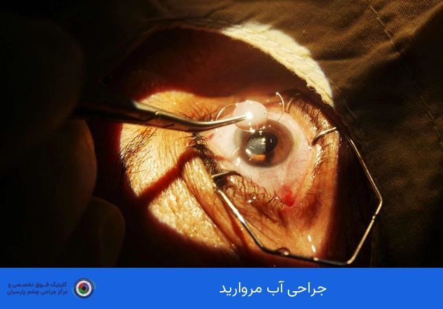 جراحی آب مروارید