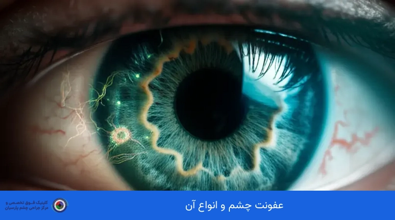 عفونت چشم و انواع آن