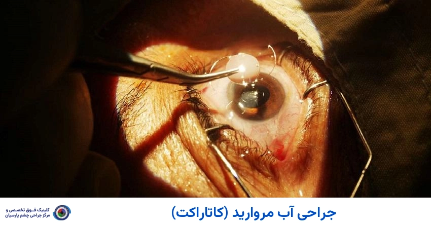 جراحی آب مروارید (کاتاراکت)