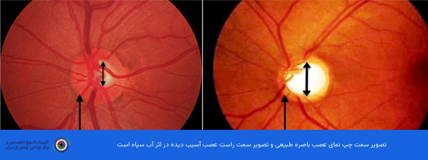 تفاوت چشم سالم و چشم مبتلا به گلوکوم