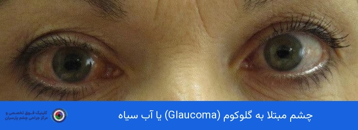چشم مبتلا به گلوکوم یا آب سیاه