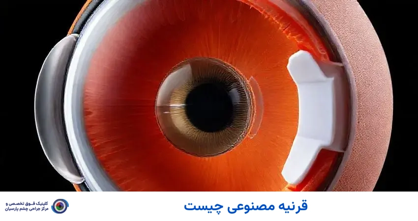 قرنیه مصنوعی چیست