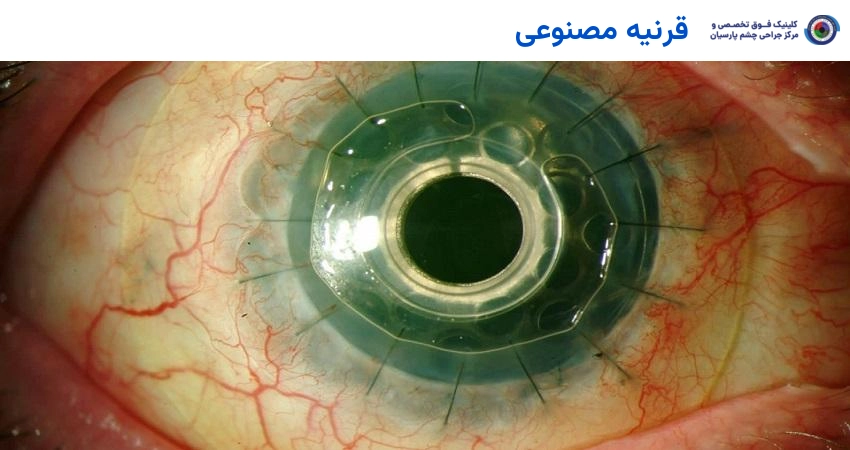قرنیه مصنوعی