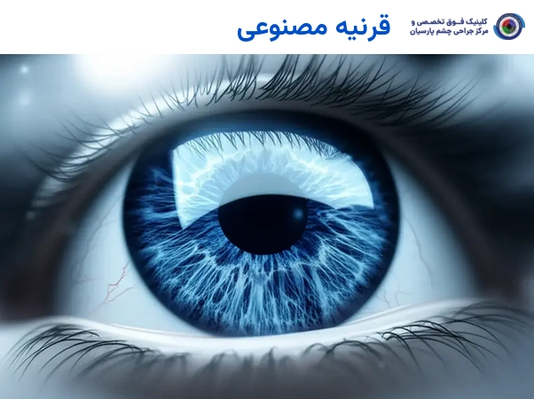 قرنیه مصنوعی