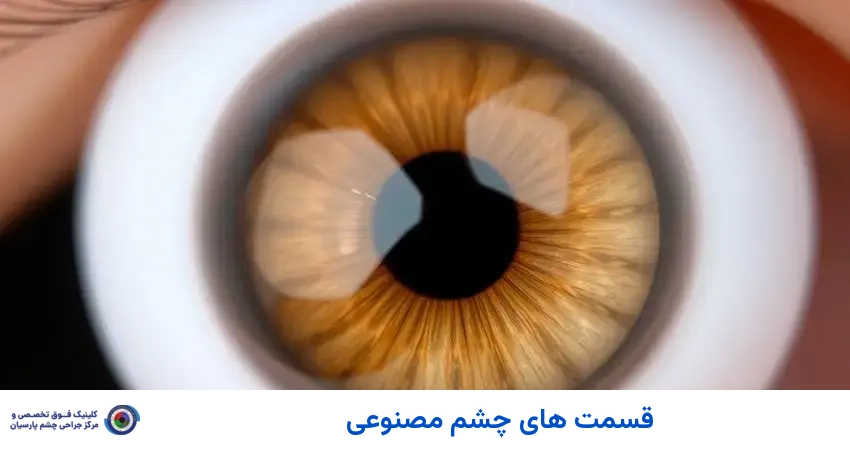 قسمت های چشم مصنوعی