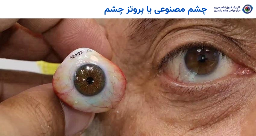 چشم مصنوعی یا پروتز چشم