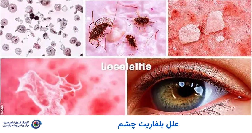 علل بلفاریت چشم