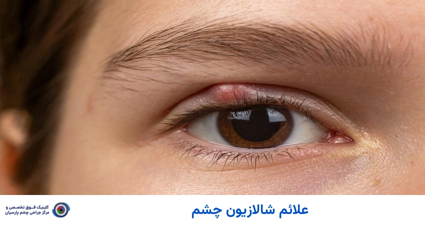 علائم شالازیون چشم