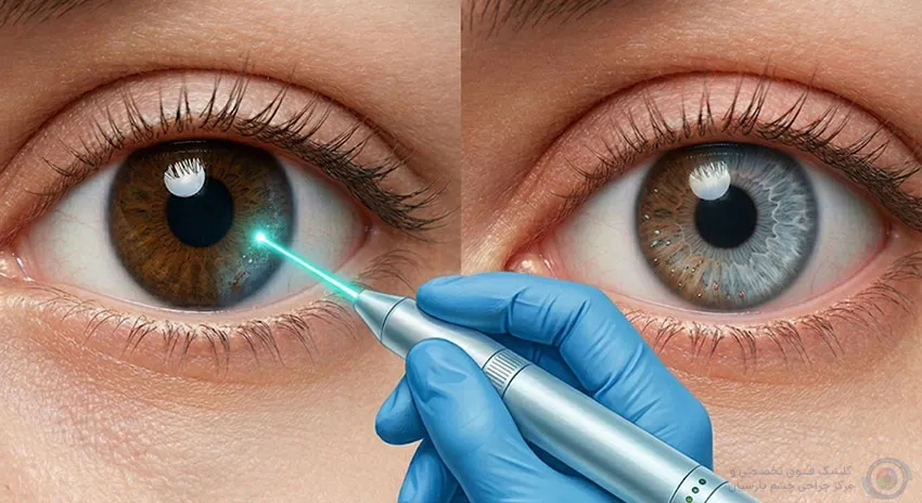 تغییر رنگ چشم با لیزر (Laser Iris Depigmentation)