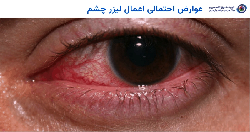 عوارض لیزر چشم