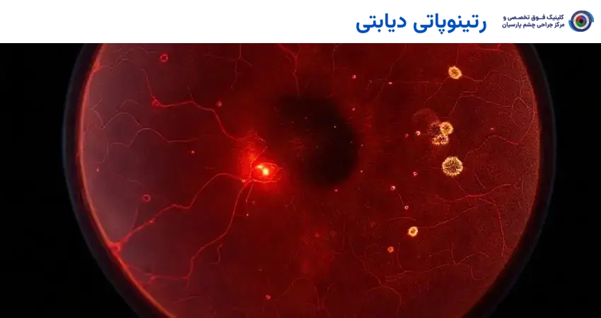 رتینوپاتی دیابتی