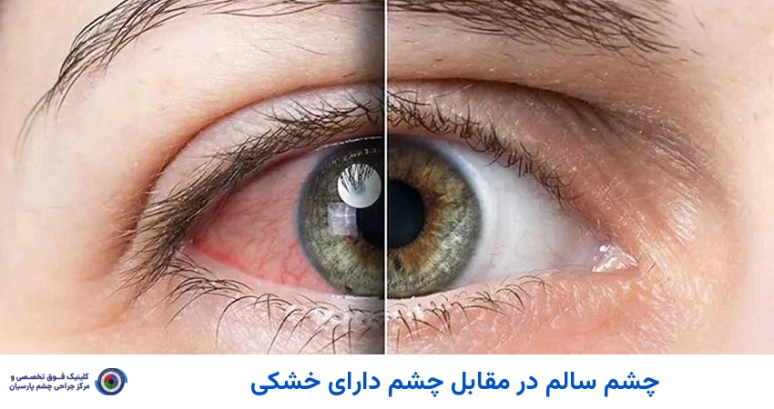 خشکی چشم در برابر چشم سالم و نرمال