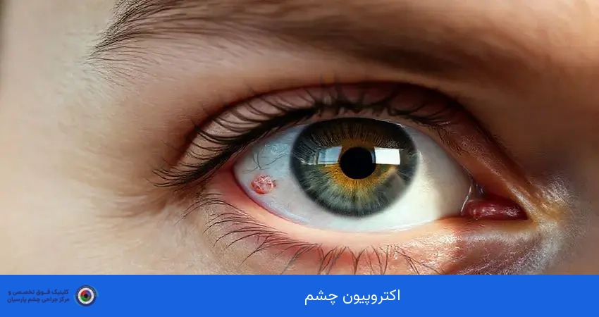 اکتروپیون چشم