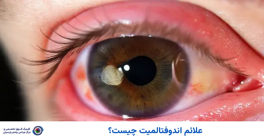 علائم اندوفتالمیت چیست؟