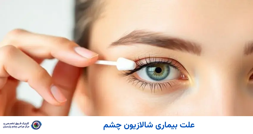 علت بیماری شالازیون چشم