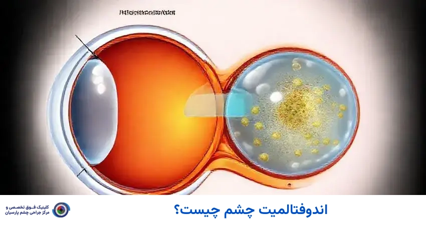 اندوفتالمیت چشم چیست؟