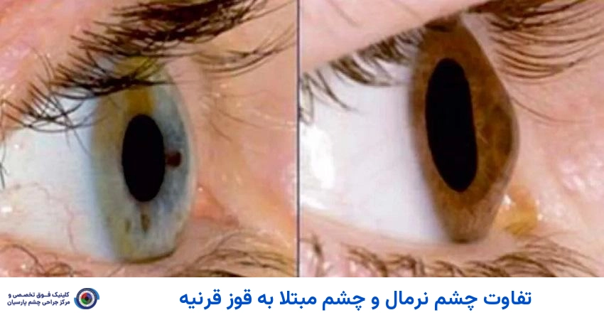 تفاوت چشم نرمال و چشم مبتلا به قوز قرنیه