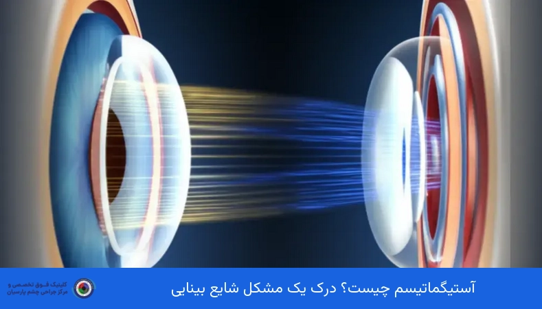 آستیگماتیسم چیست؟ درک یک مشکل شایع بینایی
