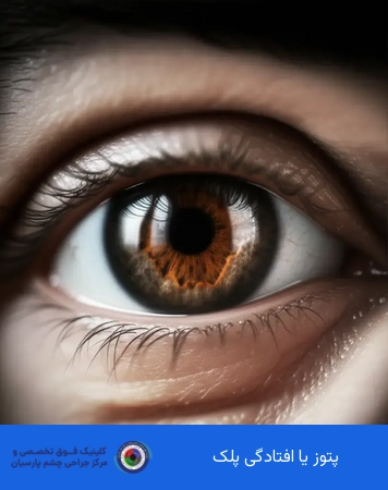 پتوز یا افتادگی پلک