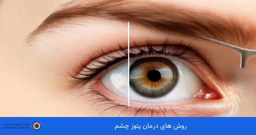 روش های درمان پتوز چشم