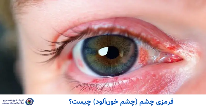 قرمزی چشم (چشم خون‌آلود) چیست؟