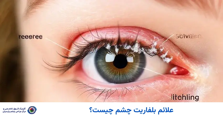 علائم بلفاریت چشم چیست؟