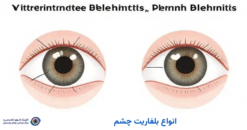 انواع بلفاریت چشم