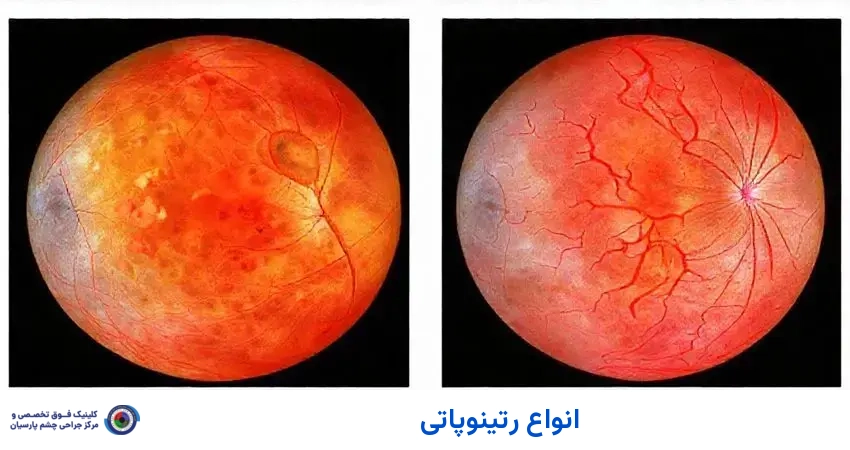 انواع رتینوپاتی
