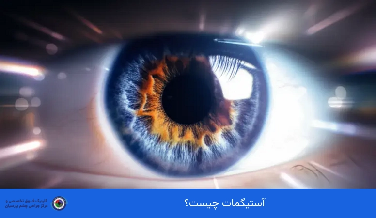 آستیگمات چیست؟