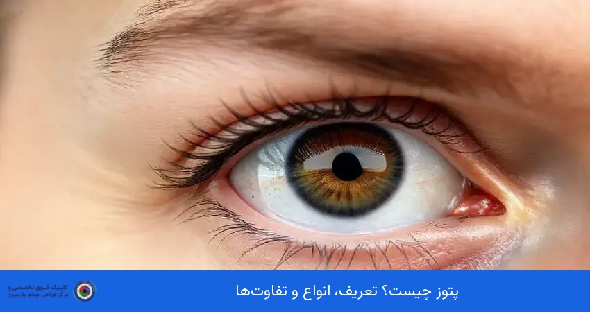 پتوز چیست؟ تعریف، انواع و تفاوت‌ها