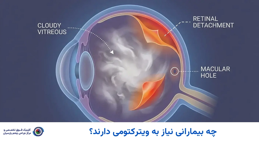 چه بیمارانی نیاز به ویترکتومی دارند؟