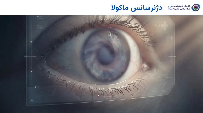 دژنرسانس ماکولا