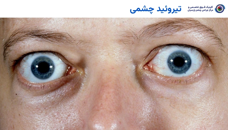 تیروئید چشمی