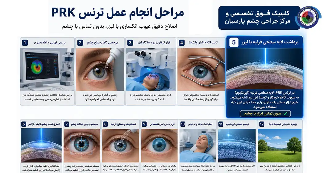 مراحل انجام عمل Trans PRK