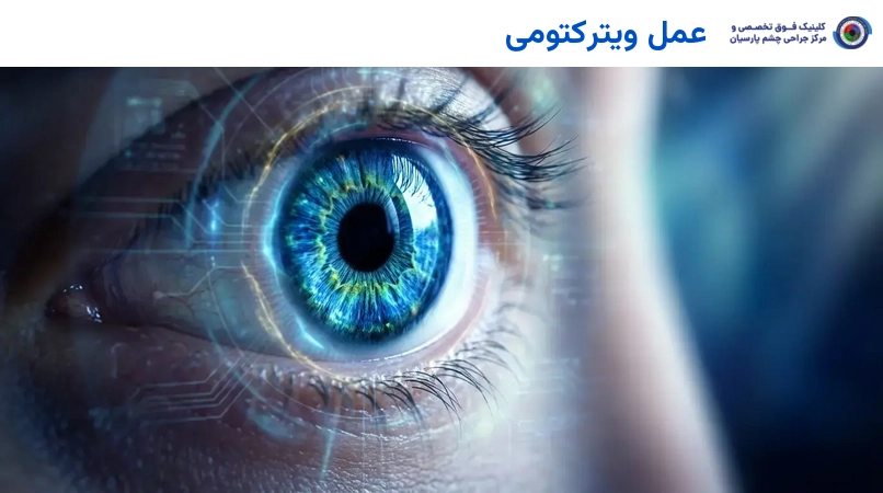 عمل ویترکتومی