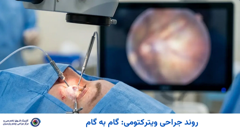 روند جراحی ویترکتومی: گام به گام