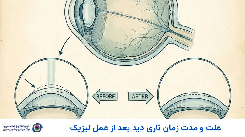 علت و مدت زمان تاری دید بعد از عمل لیزیک