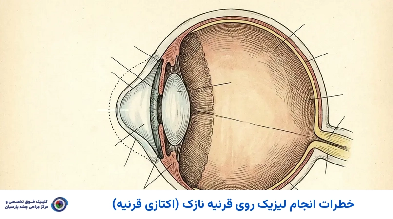 خطرات انجام لیزیک روی قرنیه نازک (اکتازی قرنیه)