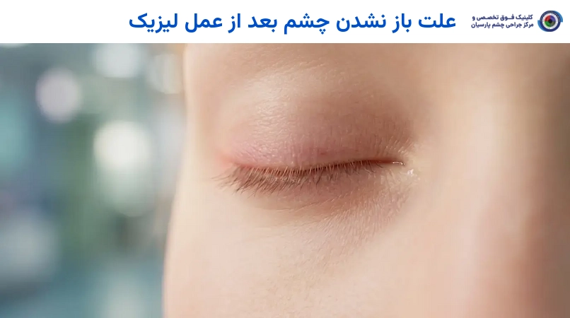 علت باز نشدن چشم بعد از عمل لیزیک
