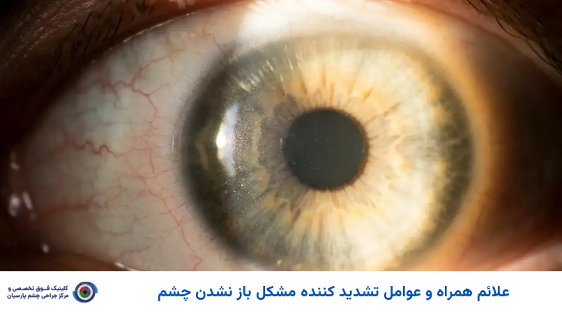 علائم همراه و عوامل تشدید کننده مشکل باز نشدن چشم