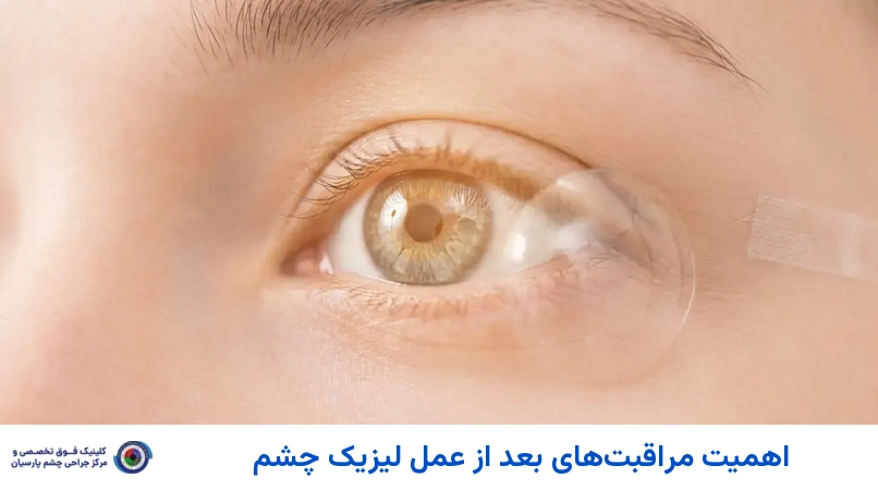 اهمیت مراقبتهای بعد از عمل لیزیک چشم