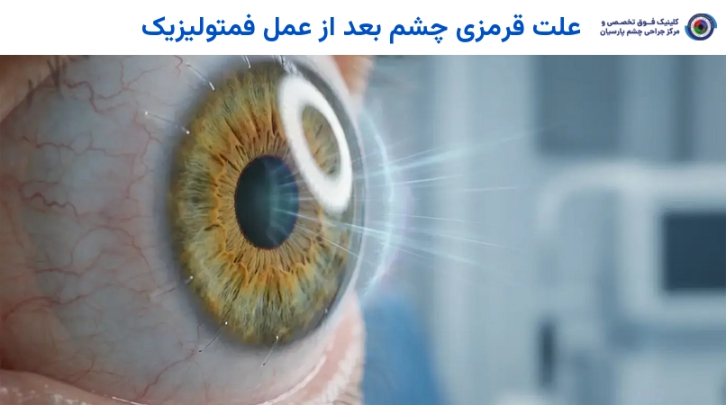 علت قرمزی چشم بعد از عمل فمتولیزیک