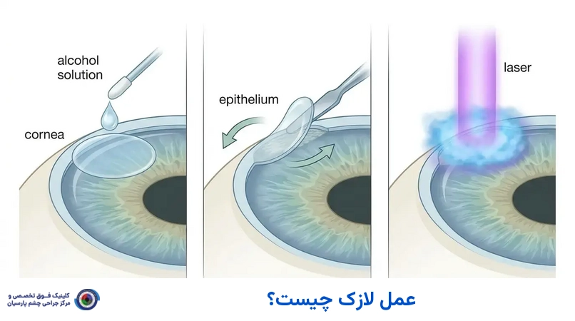 عمل لازک چیست؟