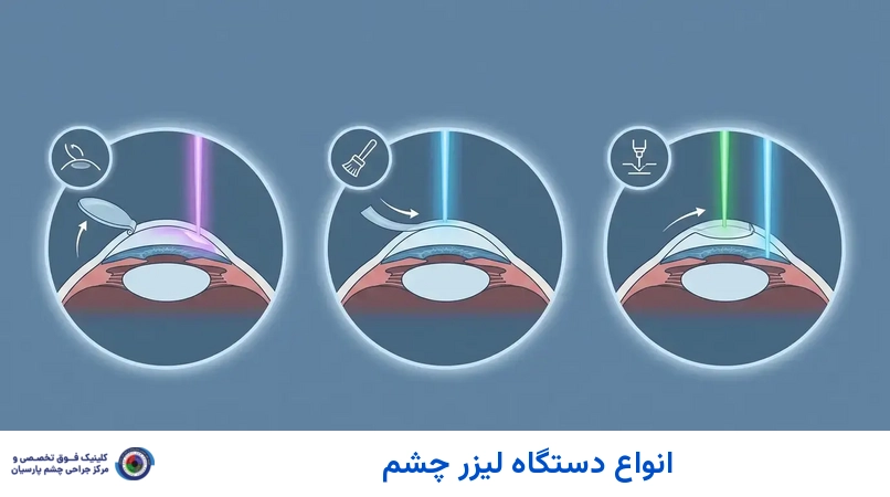 انواع دستگاه لیزر چشم