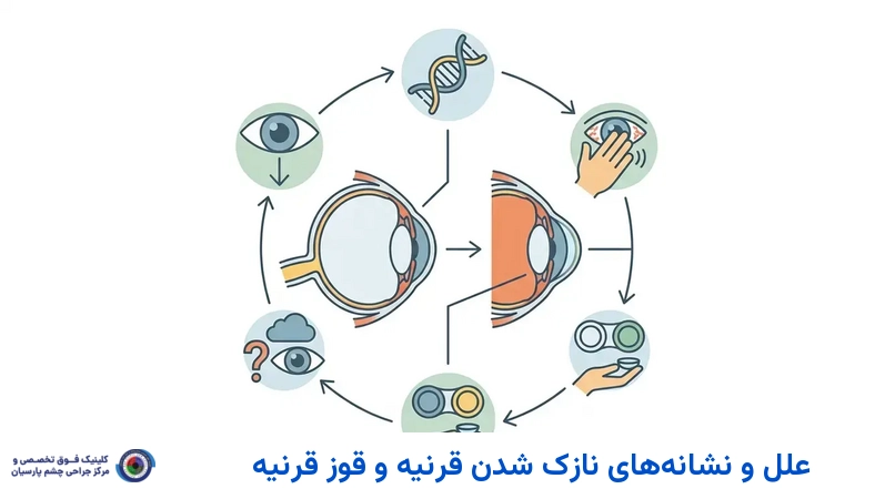 علل و نشانههای نازک شدن قرنیه و قوز قرنیه